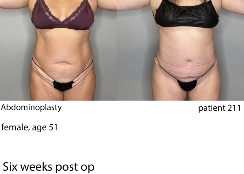 Before & After Tummy Tuck Atlanta